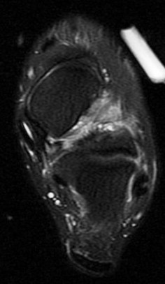 Figure 2 for case sinus tarsi  syndrome ( RID3222 )